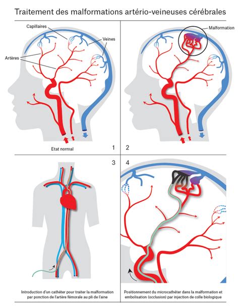 embolisation malformation artério veineuse.